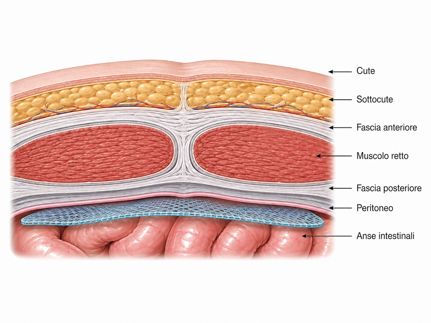 Schema anatomico: rete intraperitoneale posizionata sotto al peritoneo e a contatto con le anse intestinali