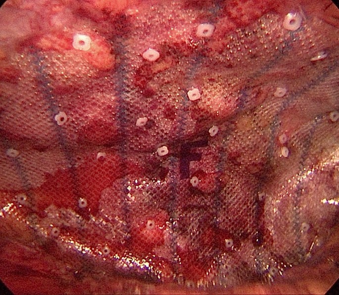Immagine intraoperatoria: protesi intraperitoneale fissata con sistemi di ancoraggio