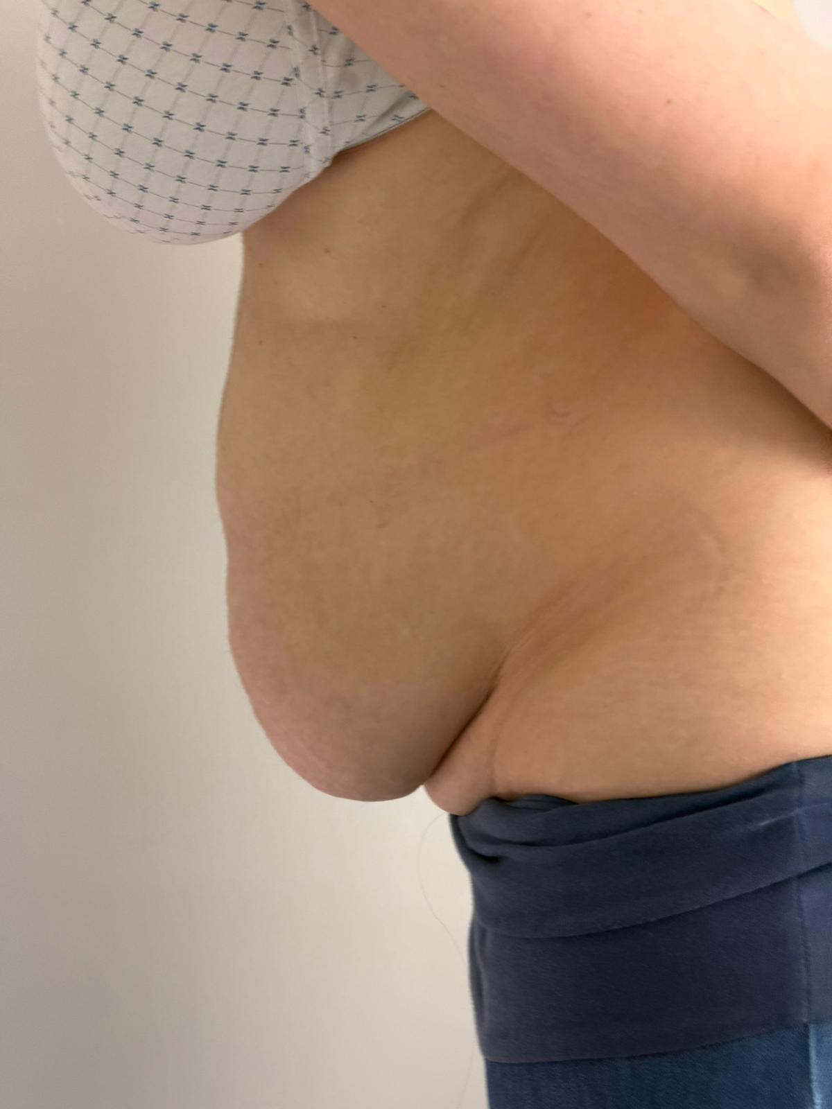 Addome con cute in eccesso e grembiule addominale, vista laterale