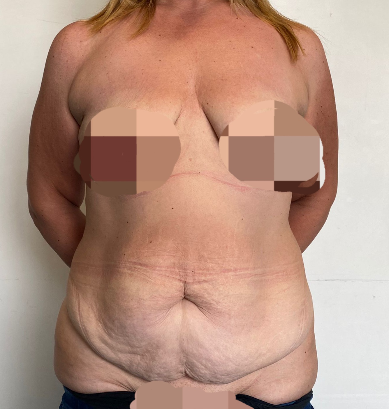 Paziente con cute addominale in eccesso e lassità cutanea — proiezione frontale