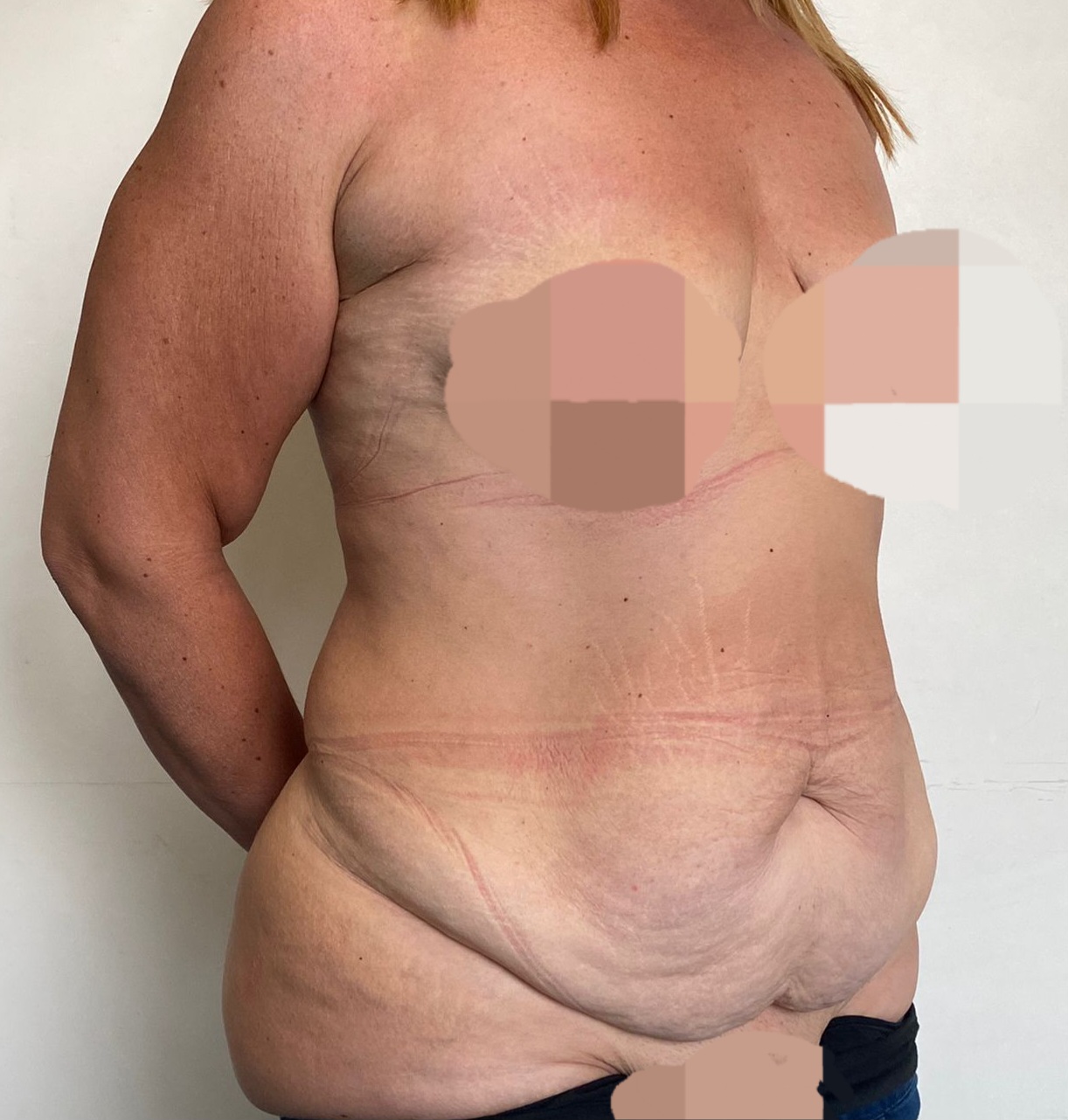 Paziente con grembiule addominale — proiezione laterale