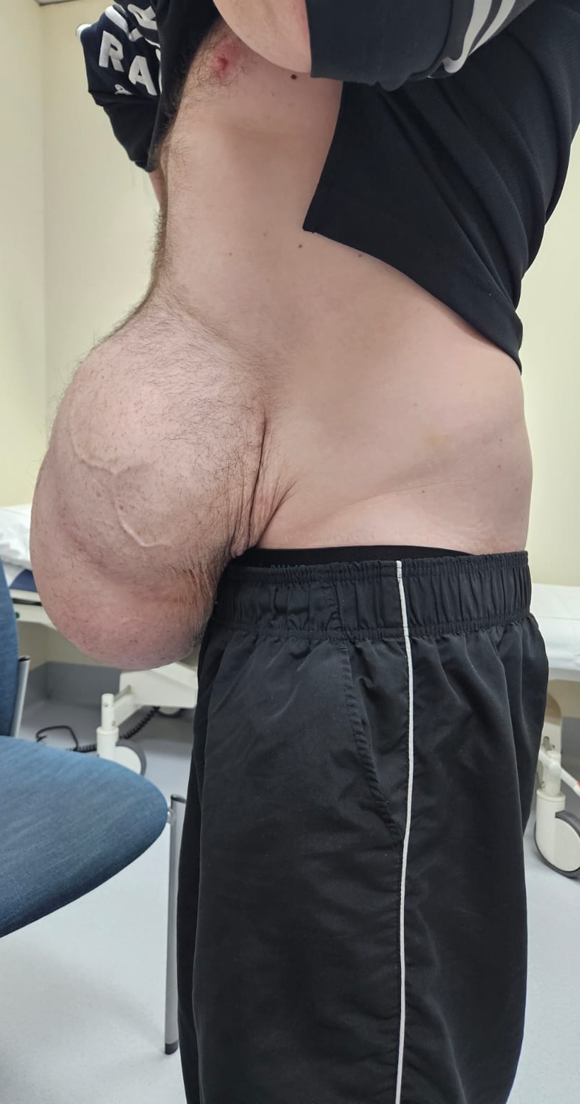 Laparocele gigante con perdita di domicilio - visione laterale