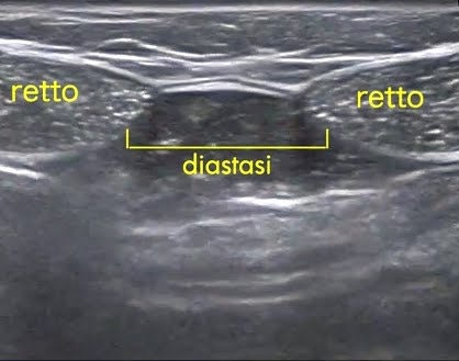 Ecografia della parete addominale: i due muscoli retti separati dalla diastasi