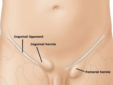 Anatomia: ernia inguinale e ernia crurale (femorale)