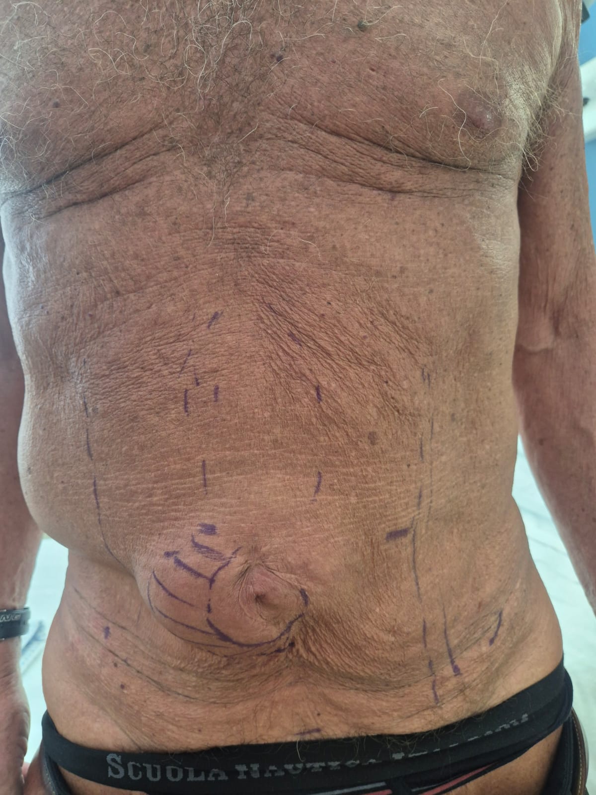 Laparocele addominale visibile in paziente con segni preoperatori