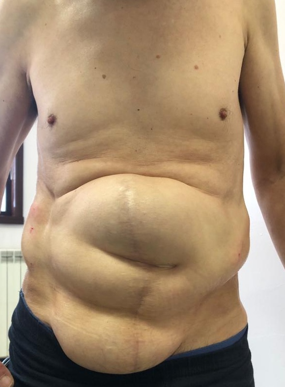 Laparocele complesso voluminoso
