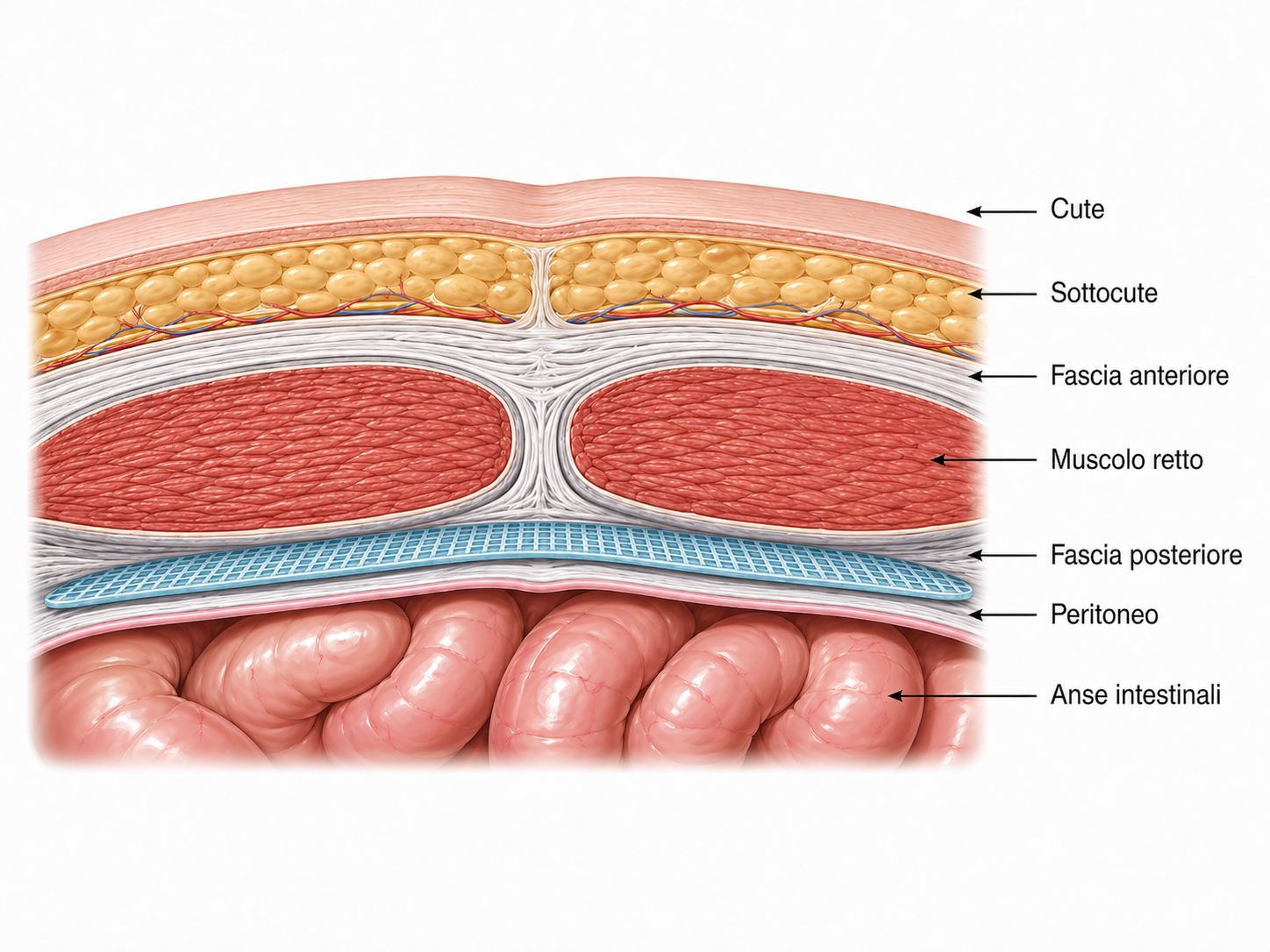 Schema anatomico del posizionamento della protesi preperitoneale tra fascia posteriore e peritoneo