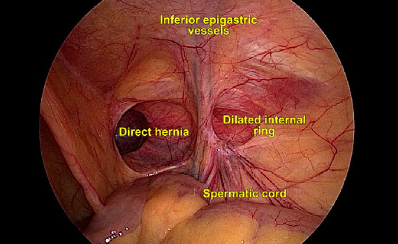 Anatomia laparoscopica della regione inguinale: ernia diretta, anello interno dilatato, vasi epigastrici, funicolo spermatico