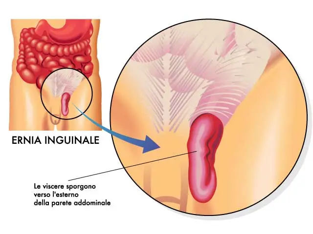 ernia inguinale